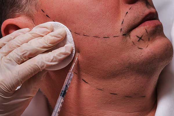 Trapianto capelli in Turchia