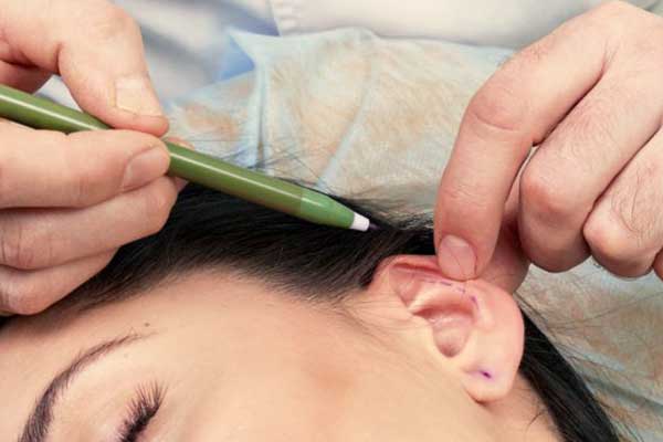 Cirugía plástica de orejas en Türkiye