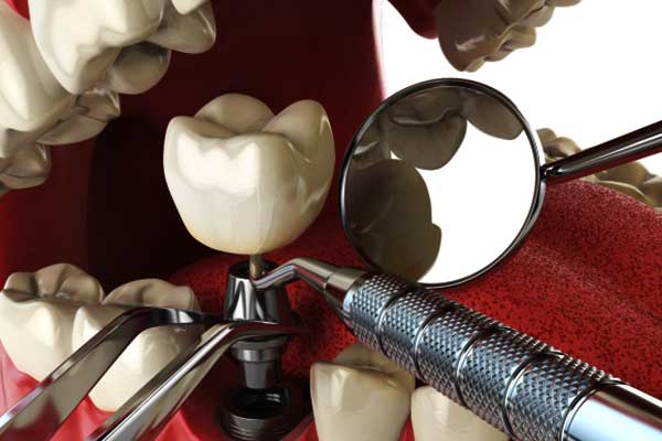 Implantes dentales en Türkiye
