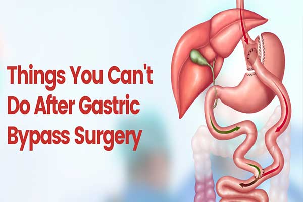 Things You Can’t Do After Gastric Bypass