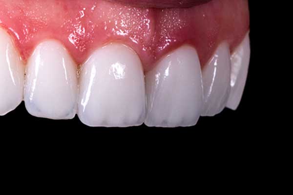 composite veneers cost full mouth