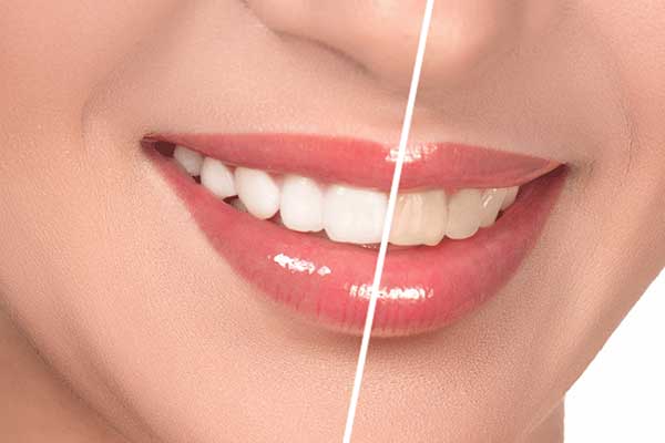 veneer for teeth whitening