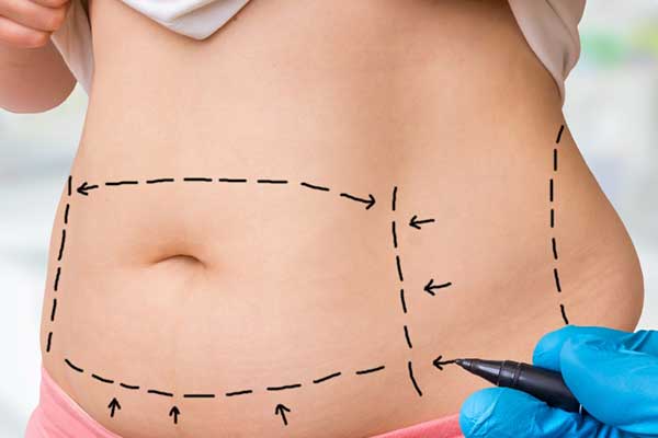 CoolSculpting Cost for Stomach in Turkey: Say Goodbye to Stubborn Belly Fat!