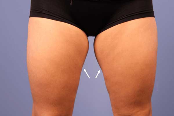 CoolSculpting Inner Thighs in Turkey: A Revolutionary Approach to Body Contouring
