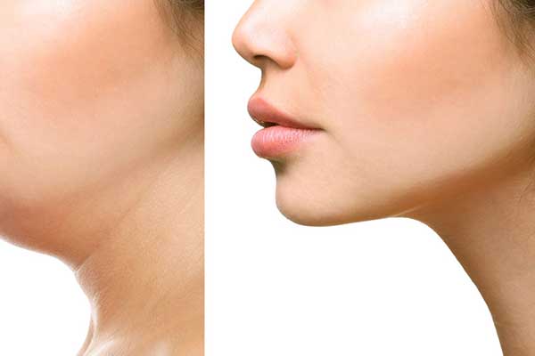 CoolSculpting Neck in Turkey: The Ultimate Guide to Non-Surgical Neck Contouring