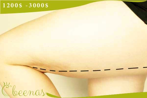 Buttock augmentation in turkey