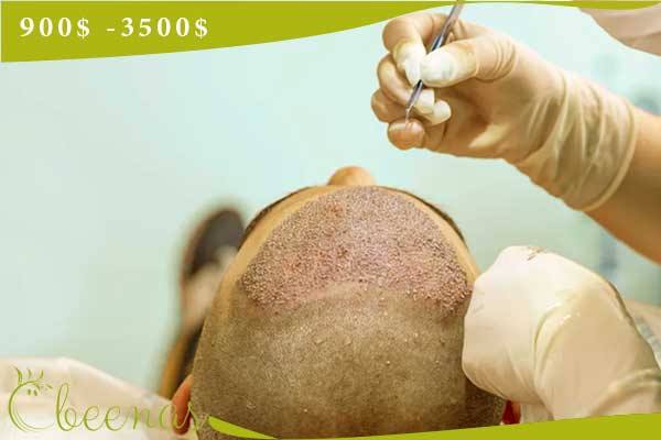 Hair transplantation in Turkey - best hair transplant clinic in turkey