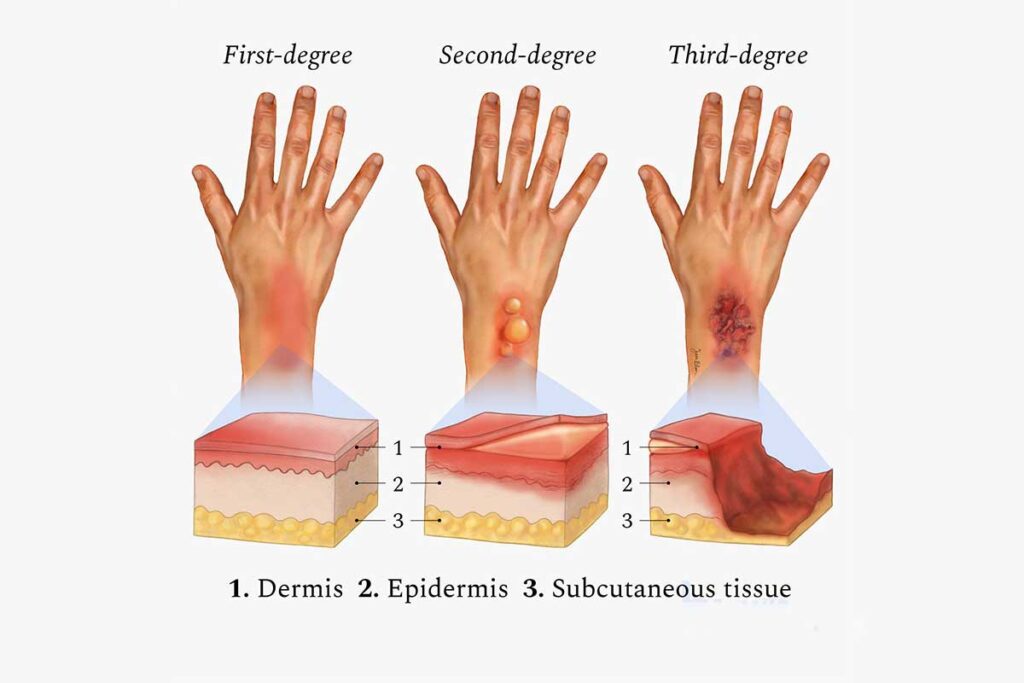 أنواع الحروق ودرجاتها