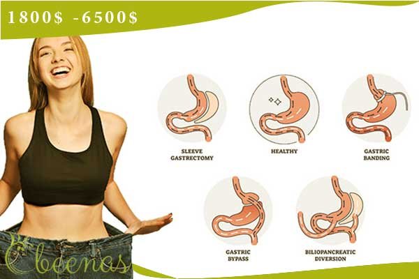 Bariatric surgery in Turkey