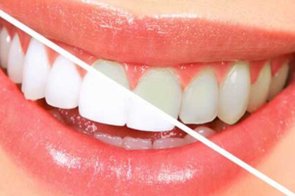 تبييض الأسنان في تركيا : دليل شامل لابتسامة مشرقة