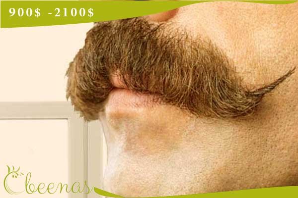 Moustache transplantation in Turkey