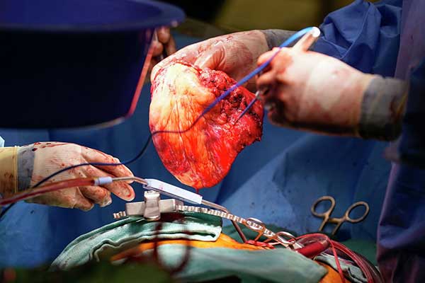 جراحة القلب في تركيا : تقنيات حديثة لصحة قلبية أفضل