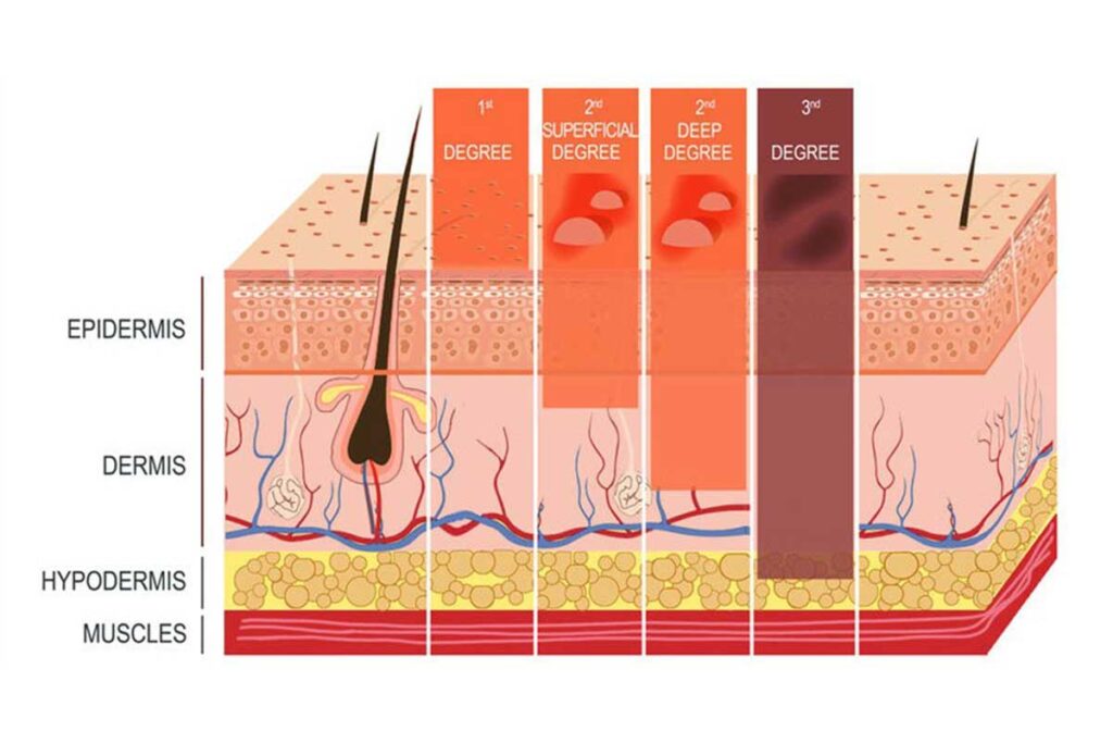 درجات الحروق التي تحتاج إلى علاج طبي عاجل