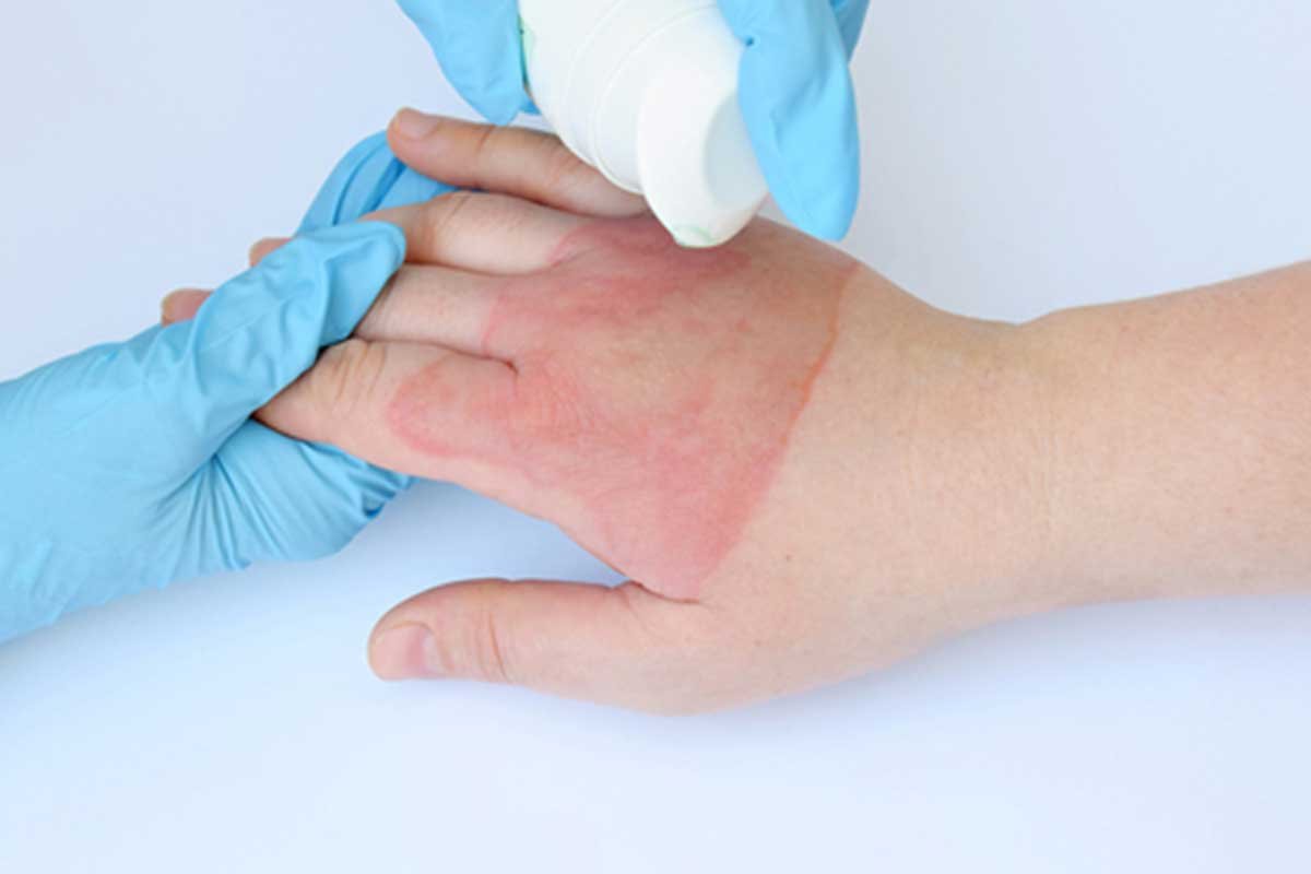 عمليات تجميل الحروق القديمة في تركيا