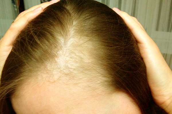 علاج فراغات الشعر في مقدمة الرأس