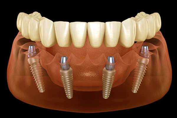 full mouth dental implants turkey price