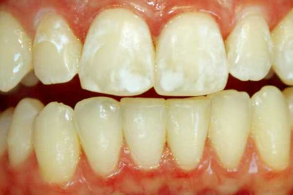 البقع البيضاء على الأسنان – الأسباب والعلاج و الوقاية