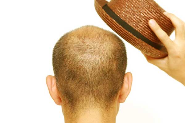 تغطية الرأس بعد زراعة الشعر – القبعة و الشماغ و ممنوعات أخرى بعد الزراعة