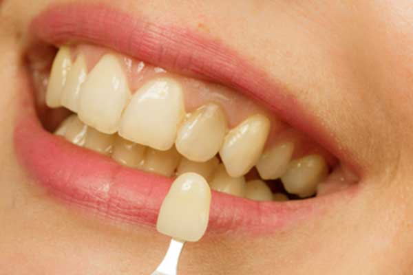 تغليف الأسنان – الجوانب والفوائد والمخاطر والتكاليف