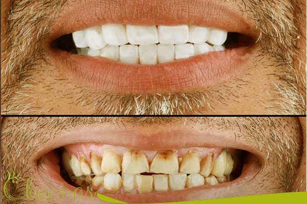 hollywood smile cost in turkey