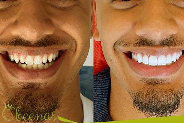 Hollywood Smile cost in Türkiye - Have a celebrity smile in just 7 days