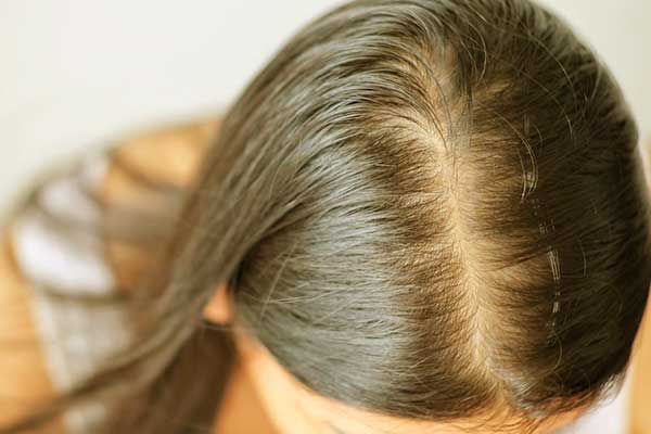 أفضل طرق علاج فراغات الشعر في مقدمة الرأس للنساء و الرجال