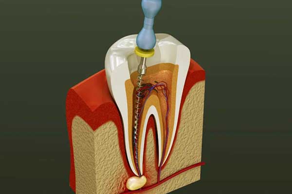 علاج قناة الجذر – دليل شامل و الحل النهائي لآلام الأسنان