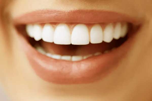 فينير الأسنان – التجميل السحري لضحايا تلف وتصبغ الأسنان