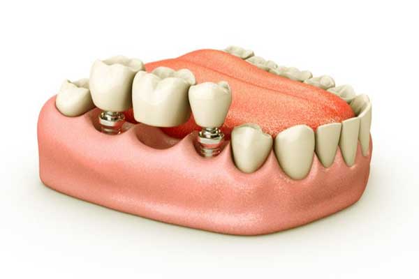 istanbul dental implants price