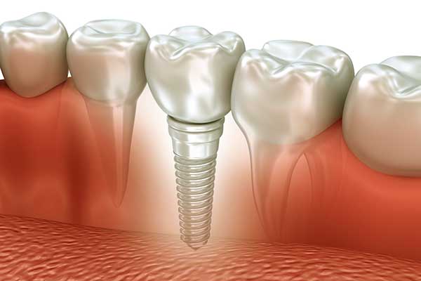 zahn implantat kosten türkei