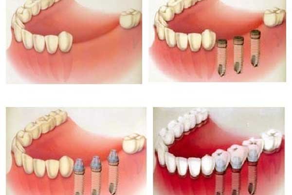 dentista en turquía opiniones