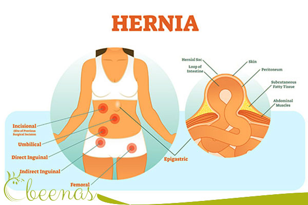 Inguinal Hernia Treatment: A Holistic Approach to Recovery