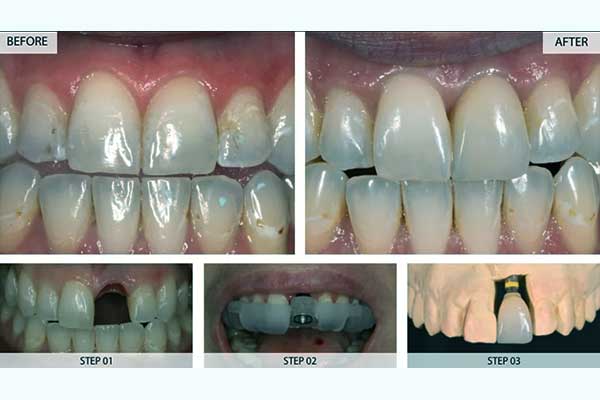 Implantes Dentales en Turquía