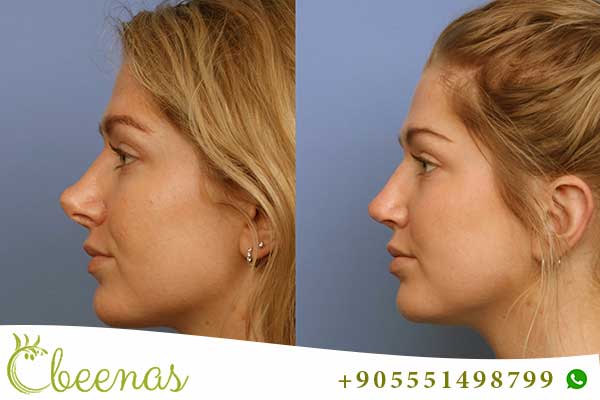 Revision Rhinoplasty in Turkey: Enhancing Beauty, Building Confidence