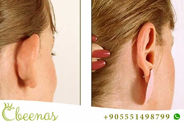 ear pinning without surgery cost in turkey