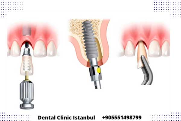 implantes dentales por 250 euros – Clínica dental en Turquía