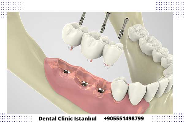implantes dentales precios económicosl en Turquía