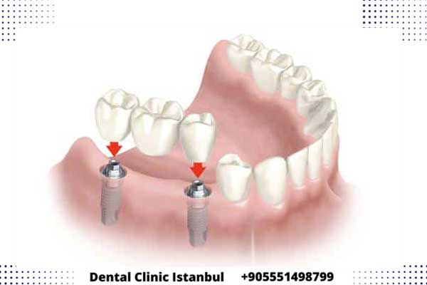implantes dentales precios económicosl