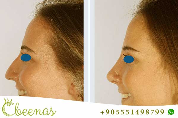 Nose Job in Turkey Experience: A Journey to Self-Confidence