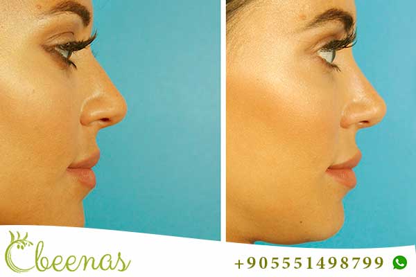 nose job turkey all inclusive Packages for a Perfect Profile