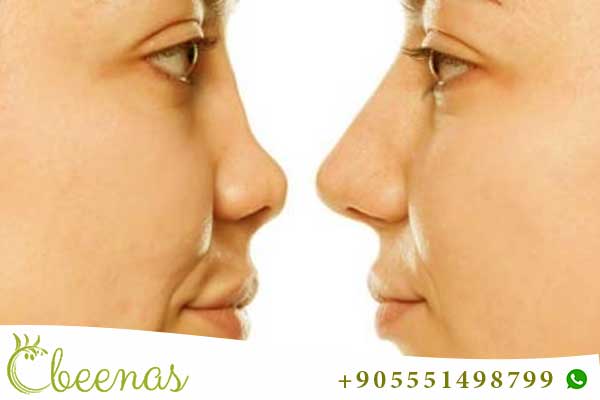 nose job in turkey gone wrong - Reasons and ways to avoid mistakes