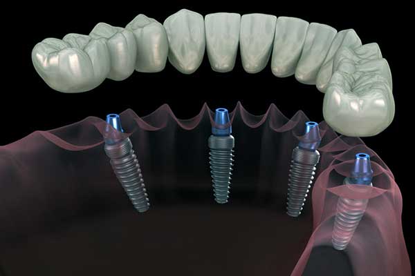 Implantes dentales cerca de mí en Turquía - Turismo dental en Estambul