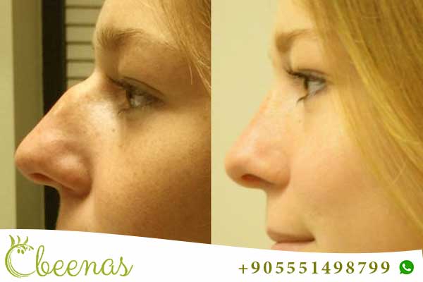 تجمع بنات عمليات تجميل الانف تركيا