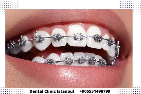 تقويم الاسنان في تركيا – احصل على ابتسامة مثالية بأفضل العلاجات