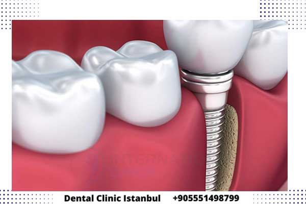 Implantes dentales cerca de mí en Turquía – Turismo dental en Estambul