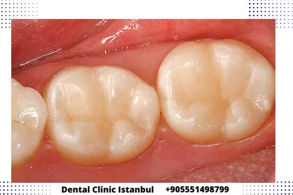 حشو الأسنان في تركيا – أنواع عالية الجودة بأسعار مناسبة