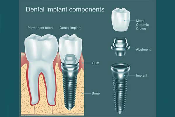 Implantes Dentales en Turquía