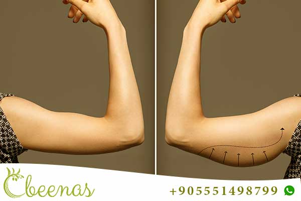 Sculpting Elegance: Arm Liposuction in Turkey