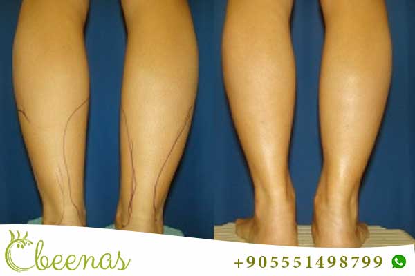 Shapely Strides: Exploring Calf Liposuction in Turkey