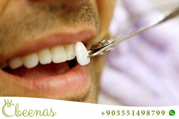 Smile Perfection: Exploring Dental Veneers in Turkey